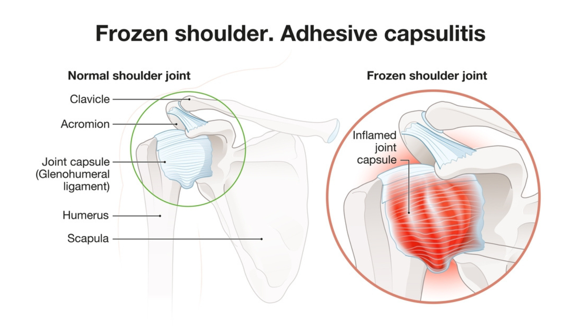 Diagram of frozen shoulder vs normal shoulder. Shockwave therapy for frozen shoulder at Propel Physiotherapy.