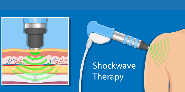 Illustration depicting shockwave therapy for frozen shoulder. 