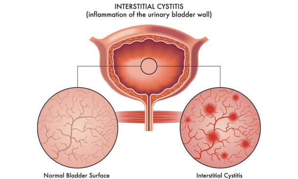 Interstitial cystitis diagram. Interstitial cystitis treatment at Propel Physiotherapy.