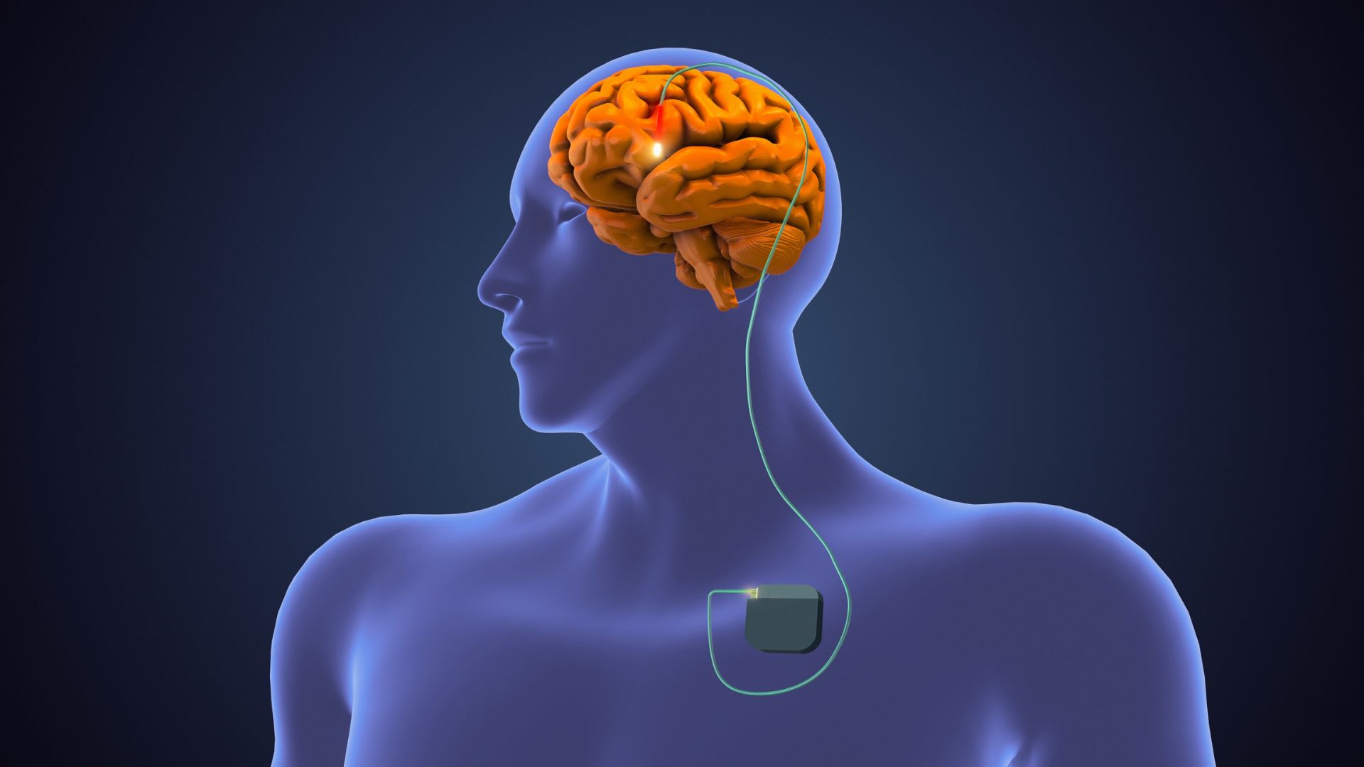 Illustration of human brain with a wire (referred to as a lead) inserted into an area deep in the brain for therapeutic reasons. Deep brain stimulation for Parkinson's disease.