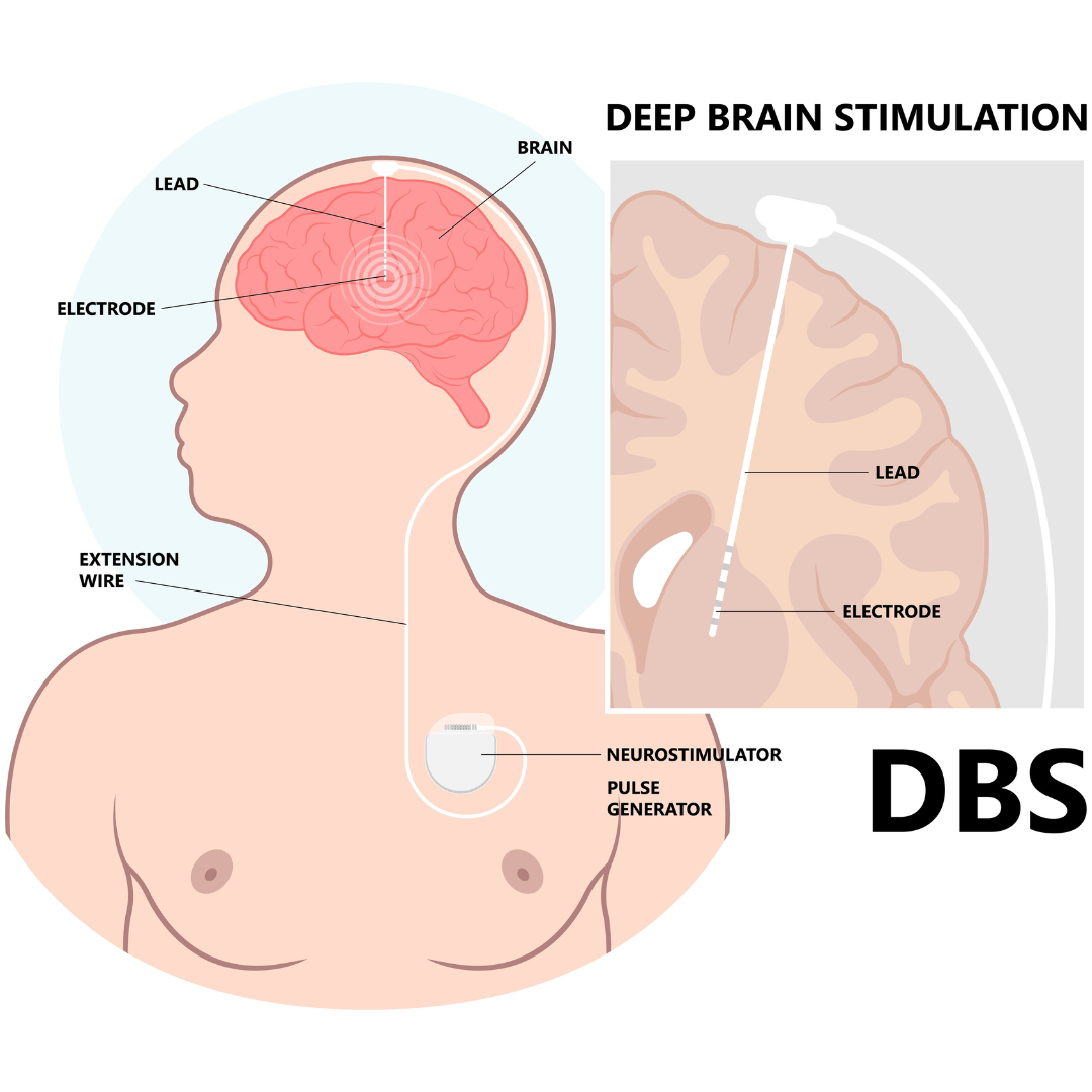 Diagram of deep brain stimulation for Parkinson's disease.