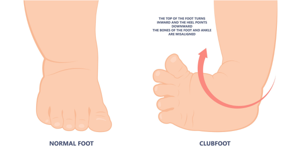 Normal foot versus clubfoot on an infant. Clubfoot treatment at Propel Physiotherapy.