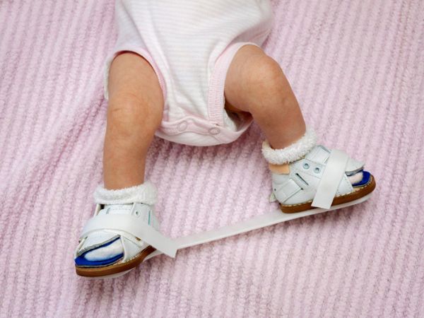 The Ponseti clubfoot brace on a newborn. Clubfoot treatment Propel Physiotherapy.