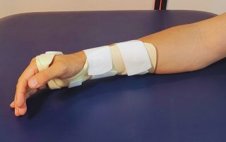 Man wearing custom splint on his right hand and lower arm. Splinting types, uses and fabrication by occupational therapists at Propel.