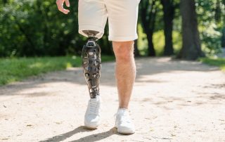 Person with prosthetic leg going for a walk. Above knee amputation rehabilitation gait training with prosthetic leg at Propel Physiotherapy.