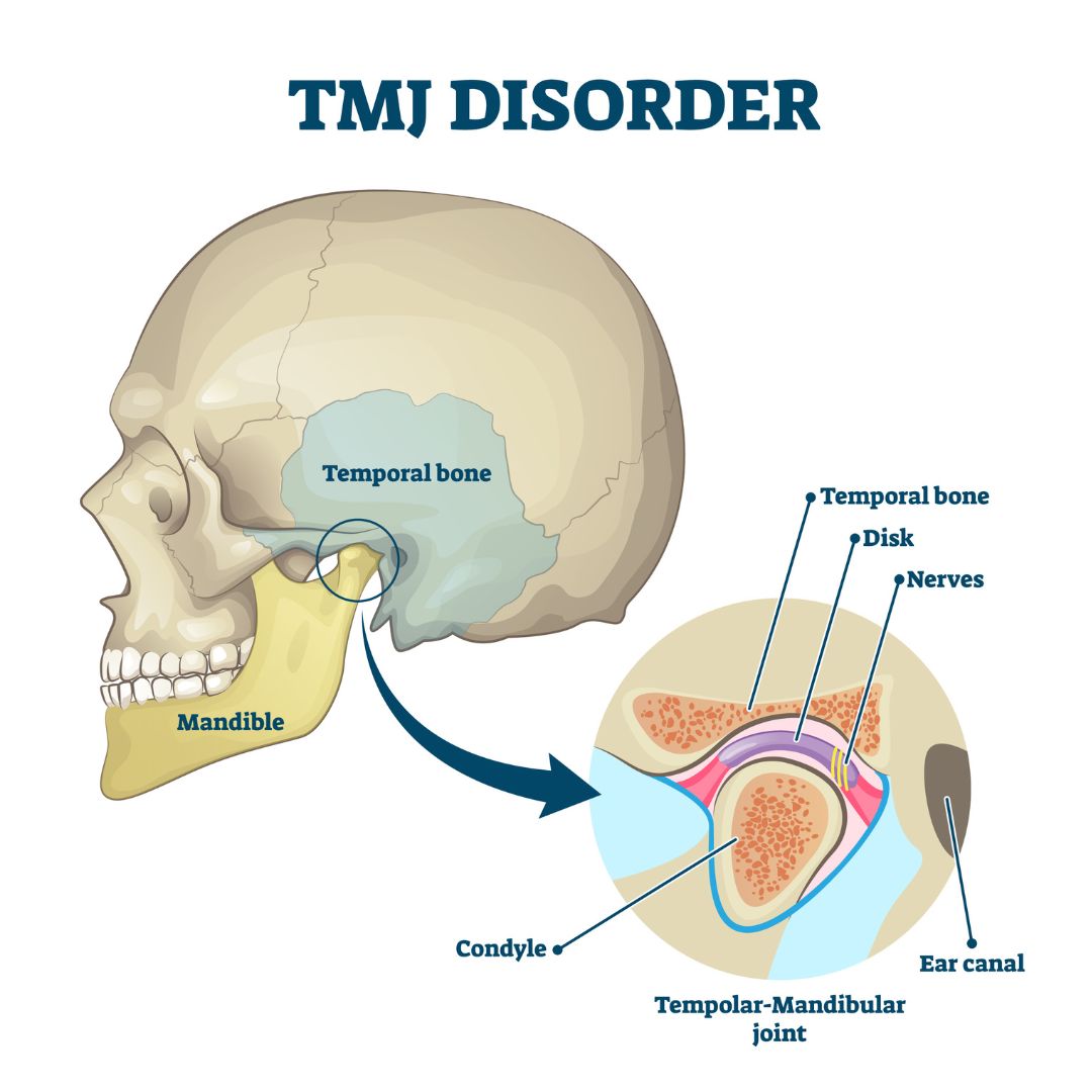 The temporomandibular Joint or TMJ anatomy. The TMJ is a well-engineered hinge and slide system that lets you talk, chew, and yawn. TMJ disorders management at Propel Physiotherapy.