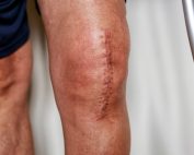 Man in shorts with visible surgery scar along the length of his left knee. Scar tissue management at Propel Physiotherapy.