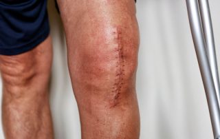 Man in shorts with visible surgery scar along the length of his left knee. Scar tissue management at Propel Physiotherapy.