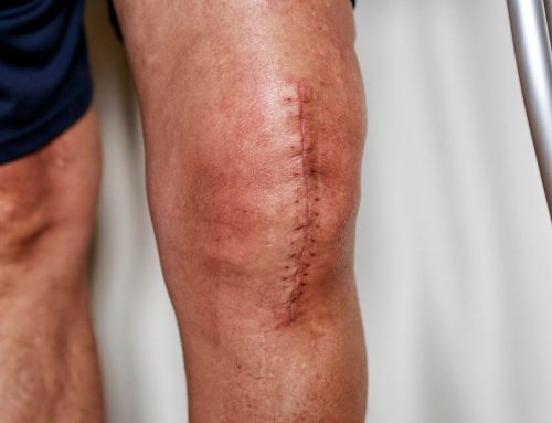 Scar Tissue Management: How to Heal, Soften, and Restore Mobility