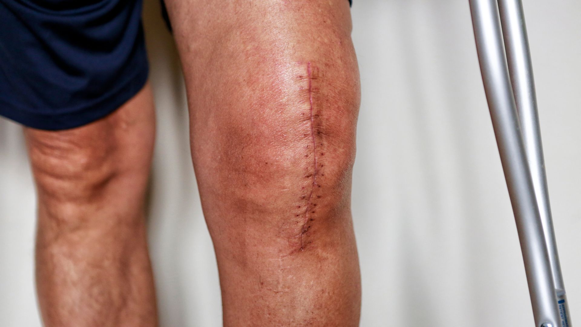 Man in shorts with visible surgery scar along the length of his left knee. Scar tissue management at Propel Physiotherapy.