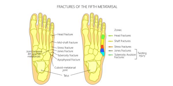Stress fracture of the fifth metatarsal diagram. Physiotherapy for stress fractures in runners at Propel Physiotherapy.