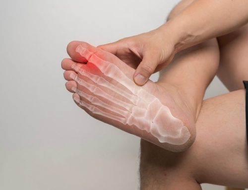 Physiotherapy for Stress Fractures in Runners
